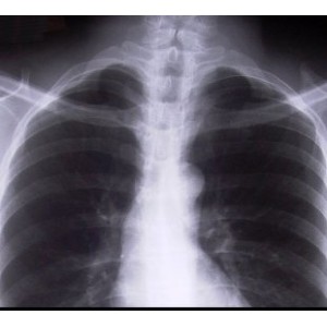 TB-MDR: prevenire si tratament