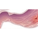 Ulcerul gastroduodenal
