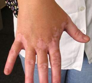 vitiligo și dureri articulare)